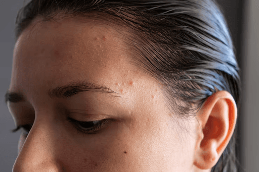 Pimples on forehead